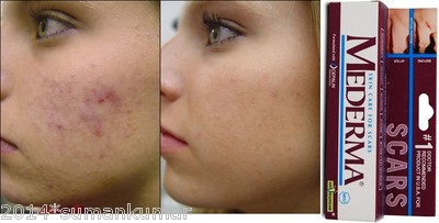 mederma for acne marks